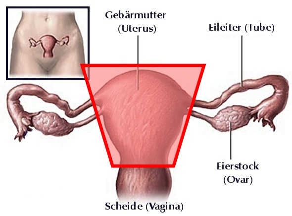 Hysterektomie (Gebärmutterentfernung) .